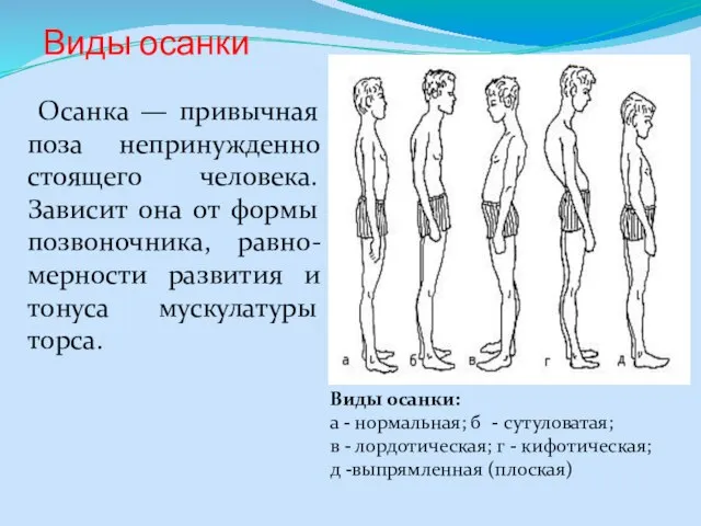 Виды осанки Осанка — привычная поза непринужденно стоящего человека. Зависит она