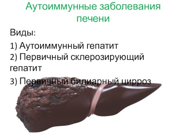 Аутоиммунные заболевания печени Виды: 1) Аутоиммунный гепатит 2) Первичный склерозирующий гепатит 3) Первичный билиарный цирроз