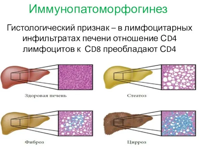 Иммунопатоморфогинез Гистологический признак – в лимфоцитарных инфильтратах печени отношение СD4 лимфоцитов к СD8 преобладают СD4