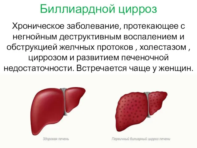 Биллиардной цирроз Хроническое заболевание, протекающее с негнойным деструктивным воспалением и обструкцией