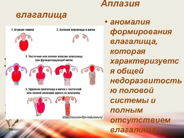 Аплазия влагалища аномалия формирования влагалища, которая характеризуется общей недоразвитостью половой системы и полным отсутствием влагалища.