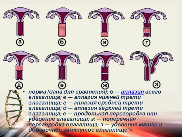 норма (дана для сравнения); б — аплазия всего влагалища; в —