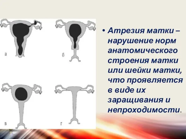 Атрезия матки – нарушение норм анатомического строения матки или шейки матки,