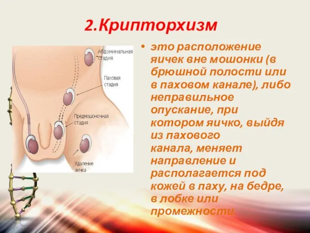 2.Крипторхизм это расположение яичек вне мошонки (в брюшной полости или в