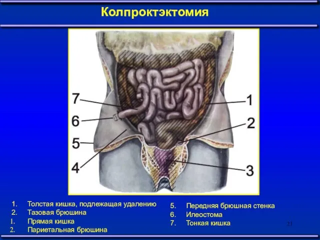 Колпроктэктомия 1. Толстая кишка, подлежащая удалению 2. Тазовая брюшина Прямая кишка