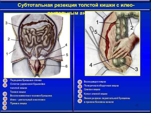 Субтотальная резекция толстой кишки с илео-ректальным анастомозом Передняя брюшная стенка Остатки