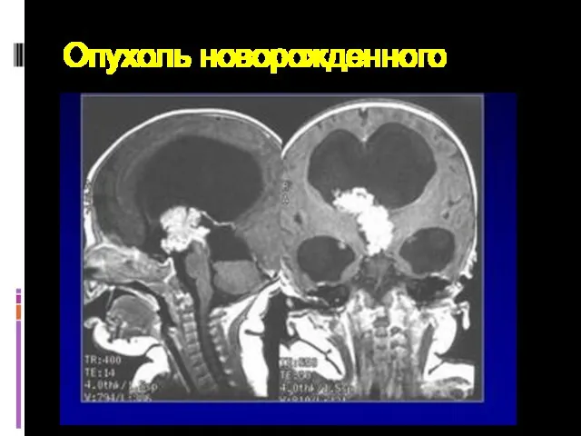 Опухоль новорожденного