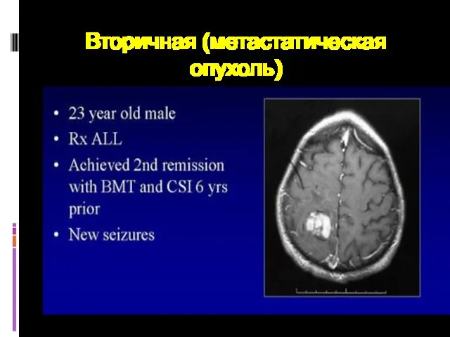 Вторичная (метастатическая опухоль)