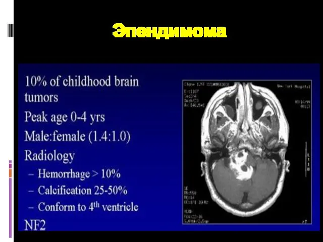 Эпендимома