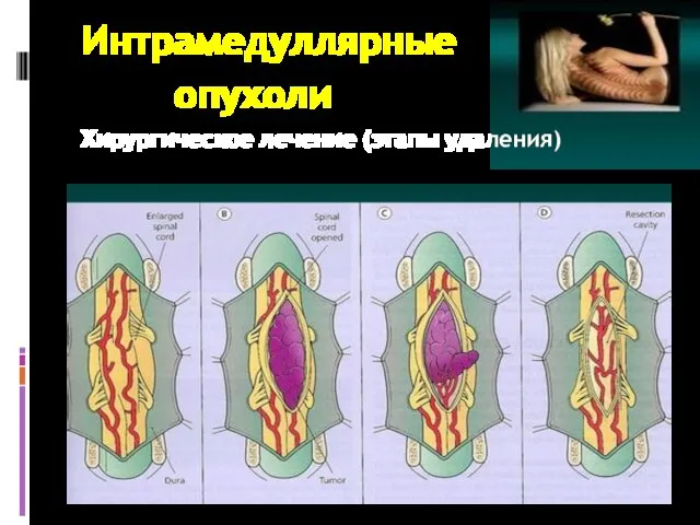 Интрамедуллярные опухоли Хирургическое лечение (этапы удаления)