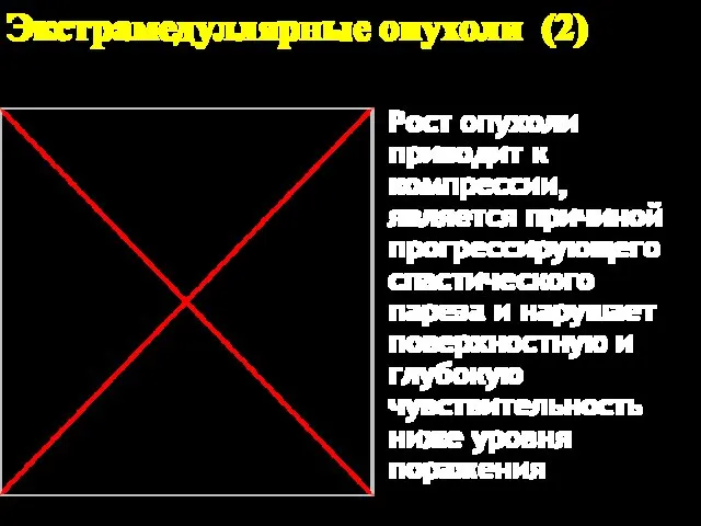 Экстрамедуллярные опухоли (2) Рост опухоли приводит к компрессии, является причиной прогрессирующего