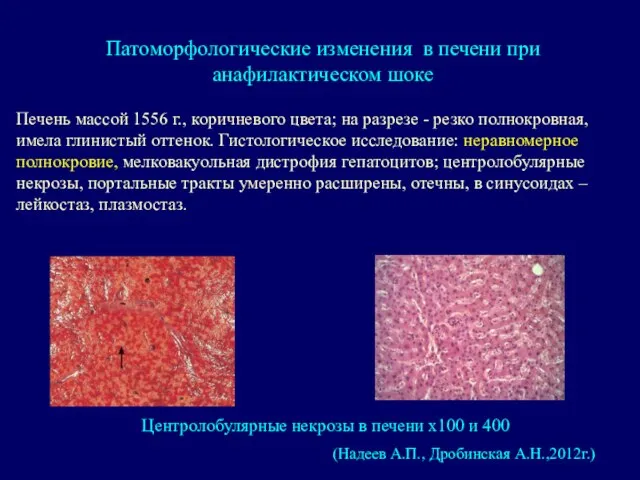 Патоморфологические изменения в печени при анафилактическом шоке (Надеев А.П., Дробинская А.Н.,2012г.)