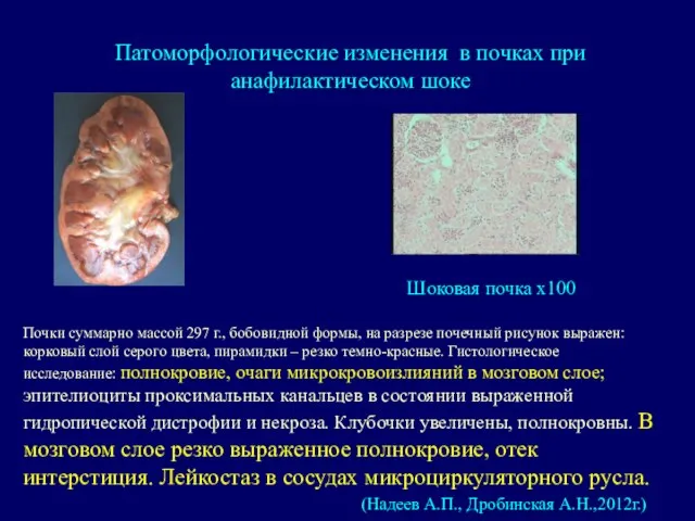 Патоморфологические изменения в почках при анафилактическом шоке (Надеев А.П., Дробинская А.Н.,2012г.)
