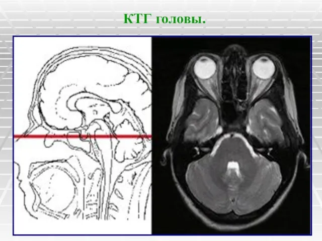 КТГ головы.