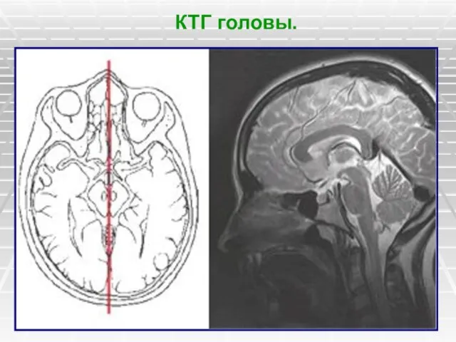 КТГ головы.