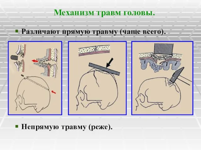 Механизм травм головы. Различают прямую травму (чаще всего). Непрямую травму (реже).