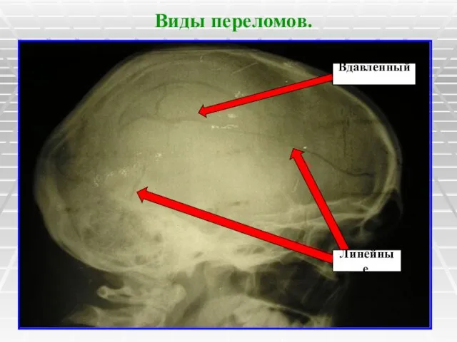 Виды переломов. Вдавленный. Линейные.