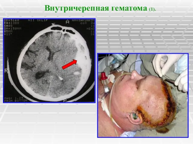 Внутричерепная гематома (1).