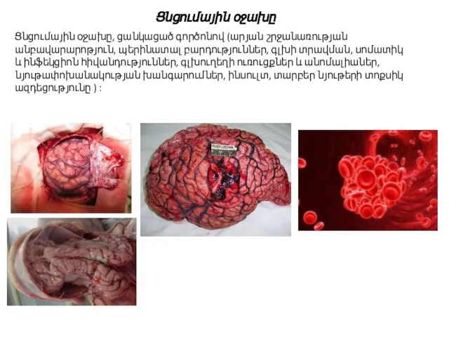 Ցնցումային օջախը, ցանկացած գործոնով (արյան շրջանառության անբավարարոթյուն, պերինատալ բարդություններ, գլխի տրավման,