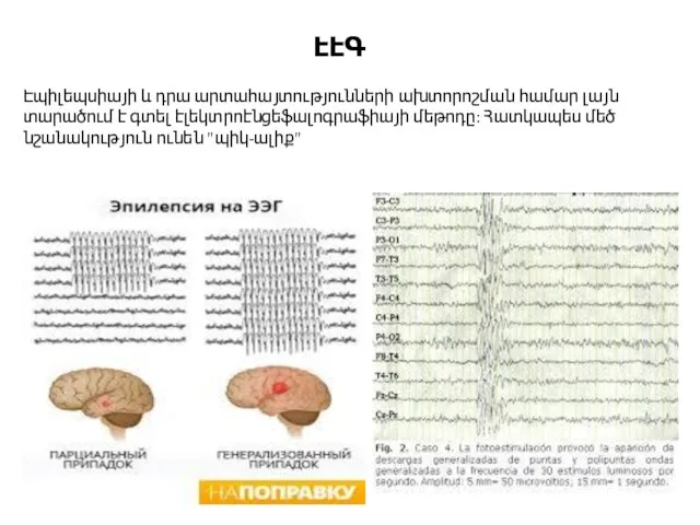 Էպիլեպսիայի և դրա արտահայտությունների ախտորոշման համար լայն տարածում է գտել էլեկտրոէնցեֆալոգրաֆիայի