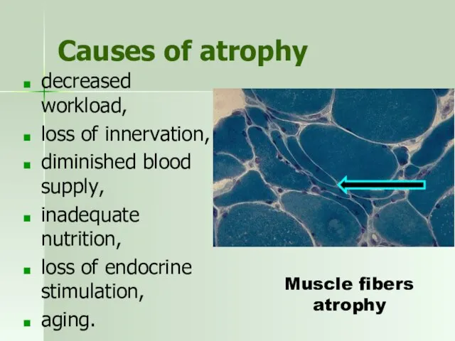 Causes of atrophy decreased workload, loss of innervation, diminished blood supply,