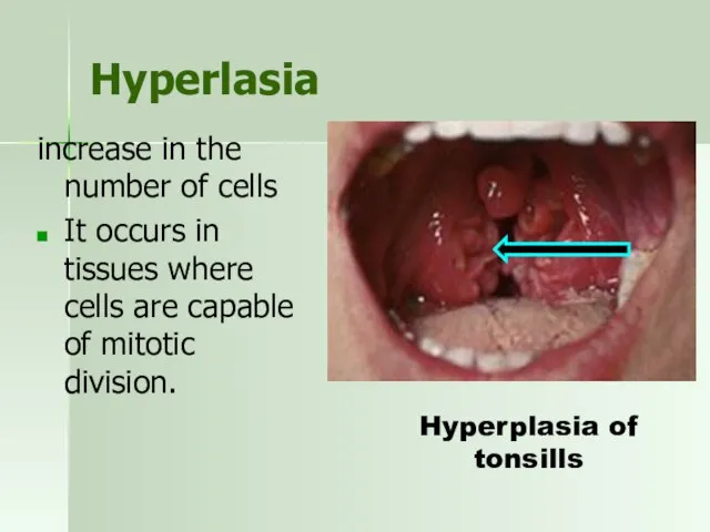 Hyperlasia increase in the number of cells It occurs in tissues