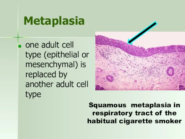 Metaplasia one adult cell type (epithelial or mesenchymal) is replaced by