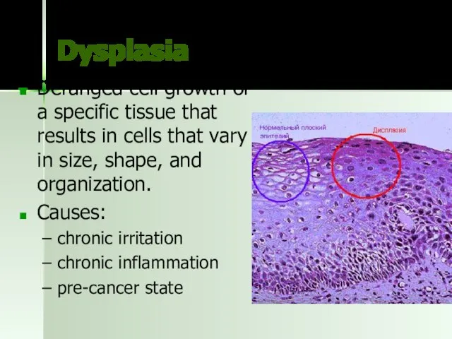 Dysplasia Deranged cell growth of a specific tissue that results in
