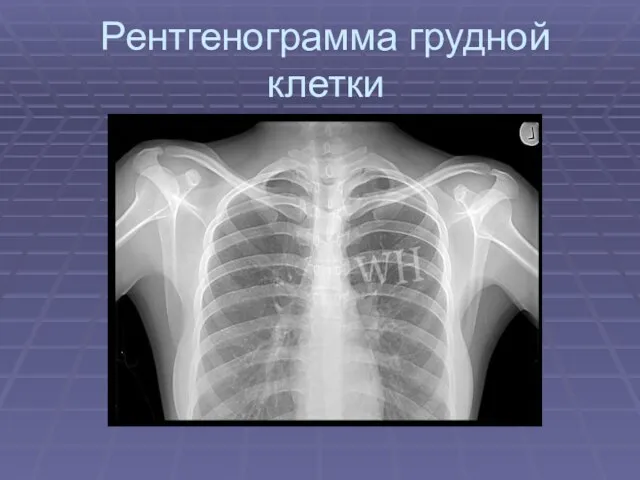 Рентгенограмма грудной клетки
