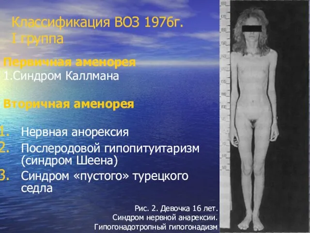 Классификация ВОЗ 1976г. I группа Первичная аменорея 1.Синдром Каллмана Вторичная аменорея