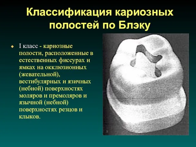 Классификация кариозных полостей по Блэку I класс - кариозные полости, расположенные