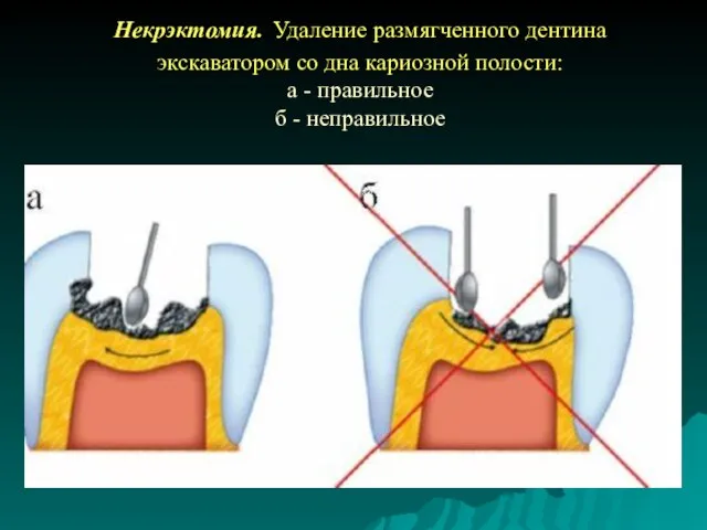 Некрэктомия. Удаление размягченного дентина экскаватором со дна кариозной полости: а - правильное б - неправильное