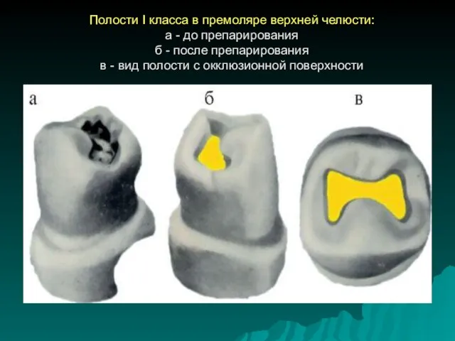 Полости I класса в премоляре верхней челюсти: а - до препарирования