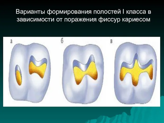 Варианты формирования полостей I класса в зависимости от поражения фиссур кариесом