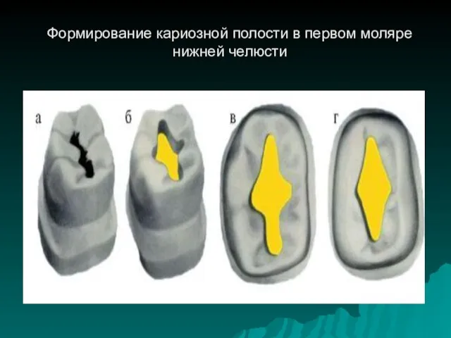 Формирование кариозной полости в первом моляре нижней челюсти