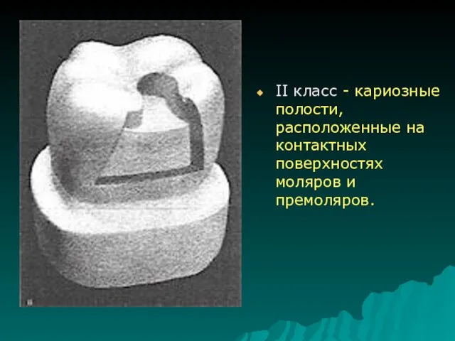 II класс - кариозные полости, расположенные на контактных поверхностях моляров и премоляров.