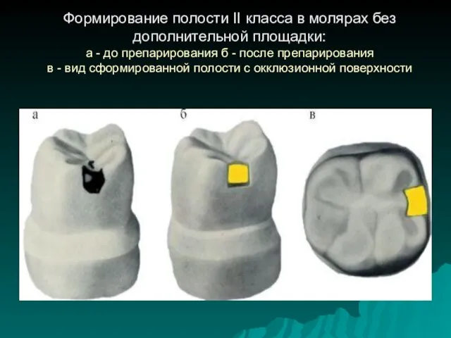 Формирование полости II класса в молярах без дополнительной площадки: а -