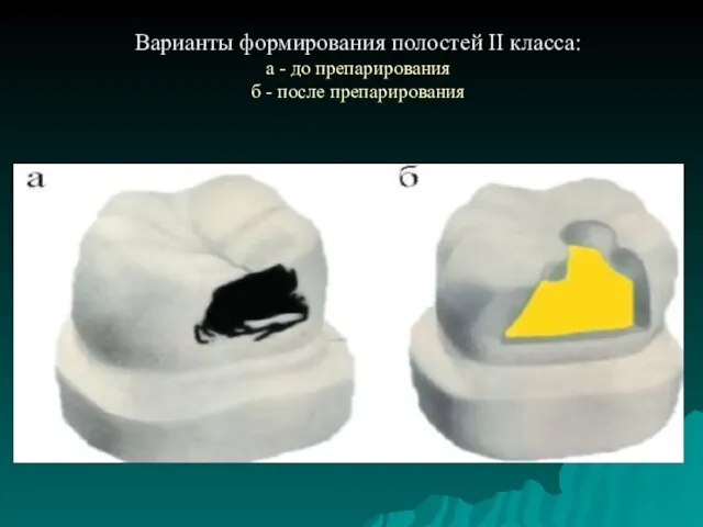 Варианты формирования полостей II класса: а - до препарирования б - после препарирования