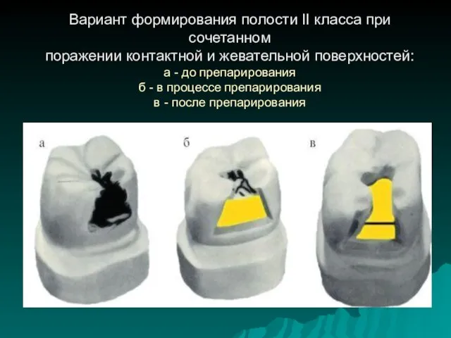 Вариант формирования полости II класса при сочетанном поражении контактной и жевательной