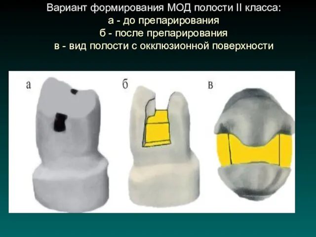 Вариант формирования МОД полости II класса: а - до препарирования б