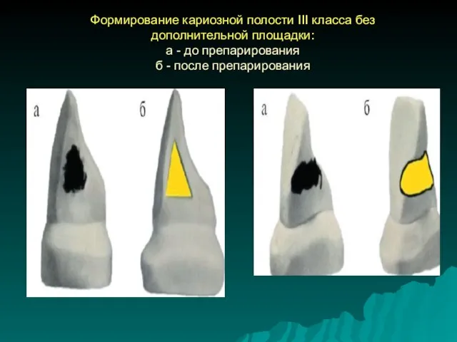 Формирование кариозной полости III класса без дополнительной площадки: а - до препарирования б - после препарирования