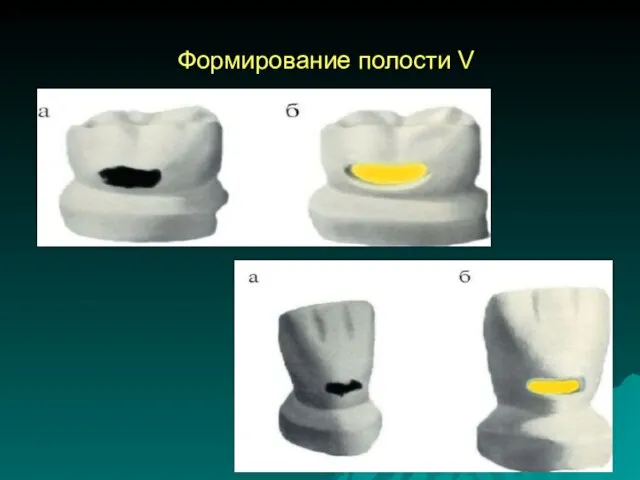 Формирование полости V