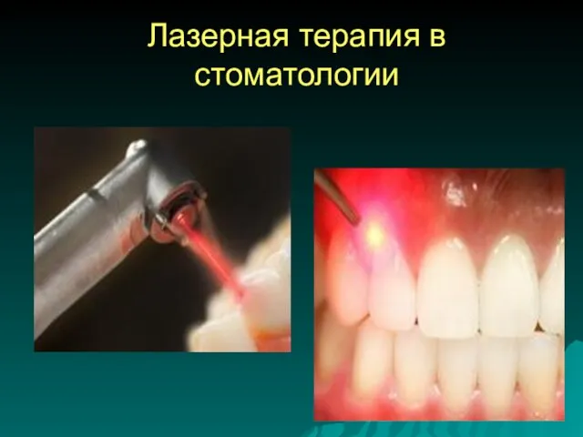 Лазерная терапия в стоматологии