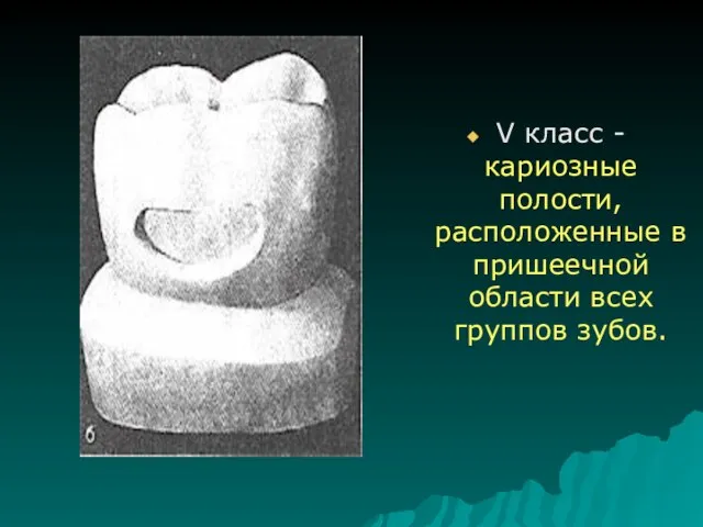 V класс -кариозные полости, расположенные в пришеечной области всех группов зубов.