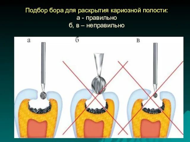 Подбор бора для раскрытия кариозной полости: а - правильно б, в – неправильно