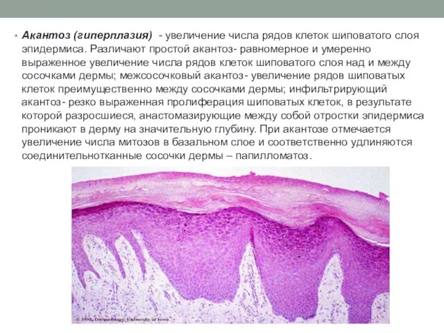 Акантоз (гиперплазия) - увеличение числа рядов клеток шиповатого слоя эпидермиса. Различают