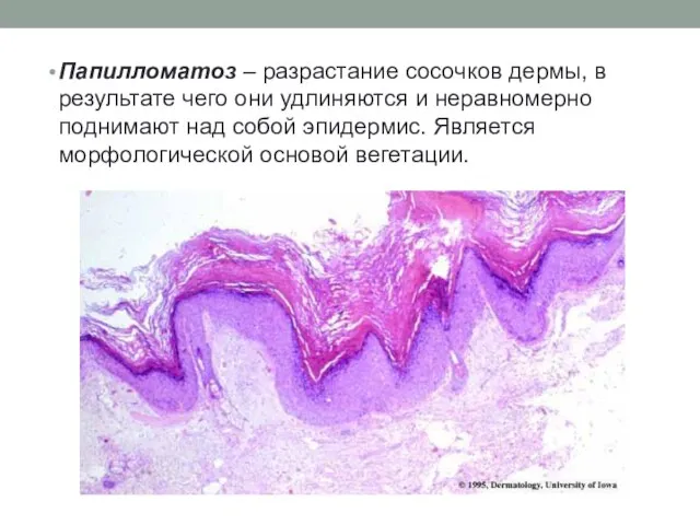 Папилломатоз – разрастание сосочков дермы, в результате чего они удлиняются и