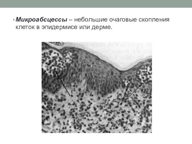 Микроабсцессы – небольшие очаговые скопления клеток в эпидермисе или дерме.