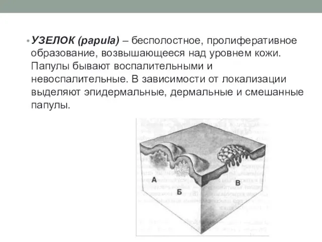 УЗЕЛОК (papula) – бесполостное, пролиферативное образование, возвышающееся над уровнем кожи. Папулы