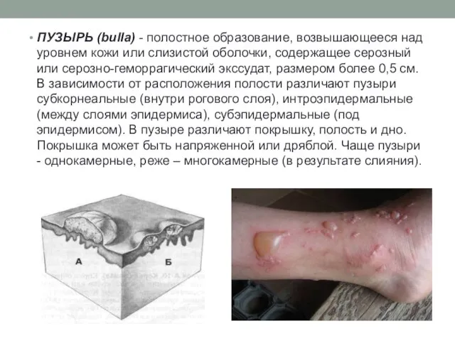 ПУЗЫРЬ (bulla) - полостное образование, возвышающееся над уровнем кожи или слизистой